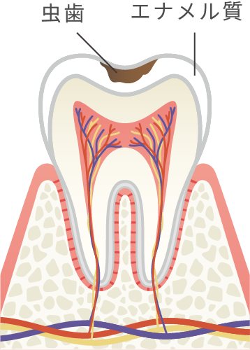 エナメル質の初期虫歯