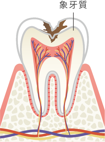 C1から進行した状態