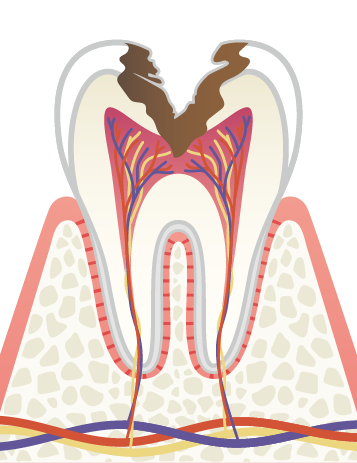 C2より進行した深い虫歯