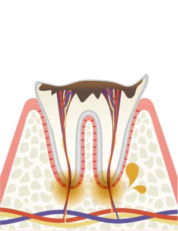 末期の虫歯
