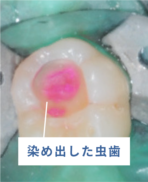染め出した虫歯