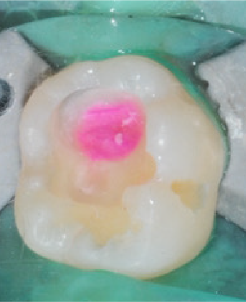 実際の虫歯治療