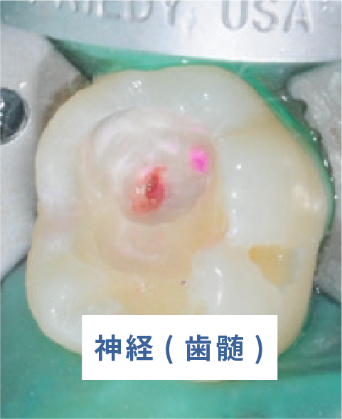 神経(歯髄)
