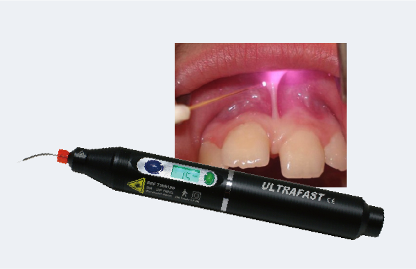 歯科用レーザー