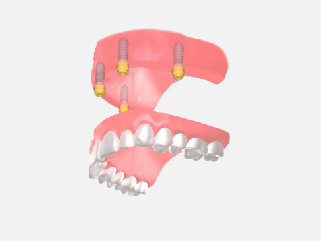 インプラントオーバーデンチャー