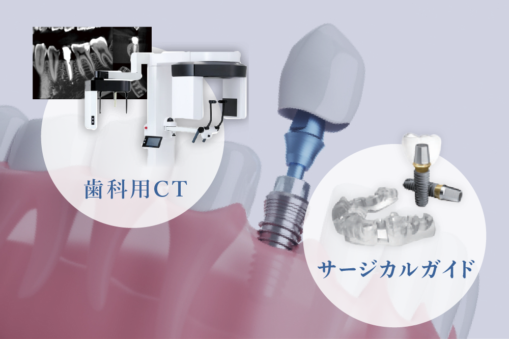 歯科用CT・サージカルガイド