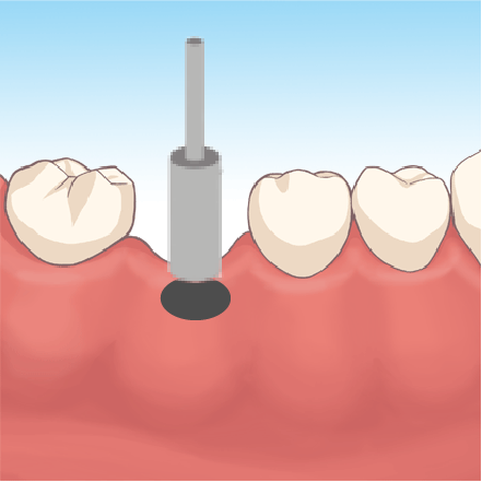 フラップレス手術