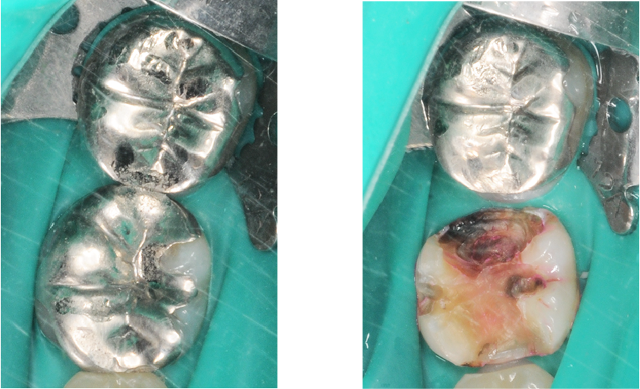 銀歯の中で虫歯が再発した症例