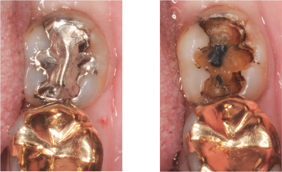 銀歯の中で虫歯が再発した症例