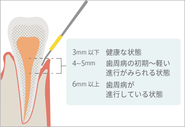 歯周ポケットの深さ