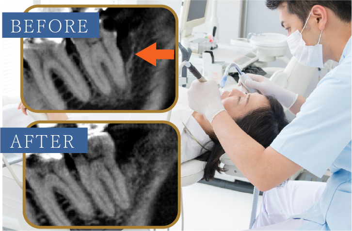 歯周組織再生療法