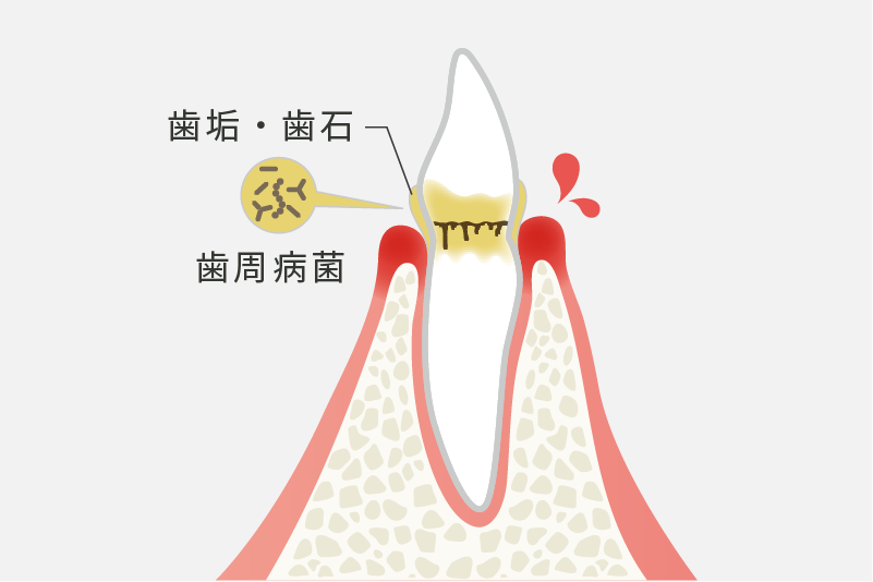 歯肉炎