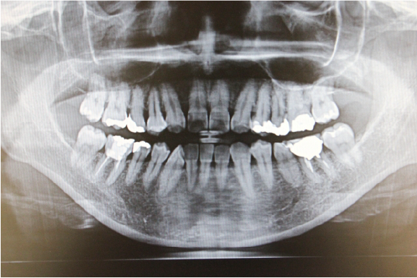 レントゲン検査