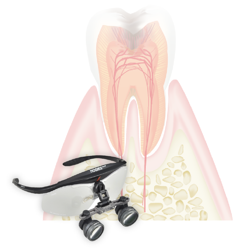 一般的な根管治療