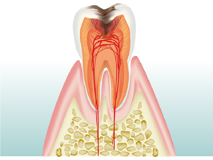 根管治療とは