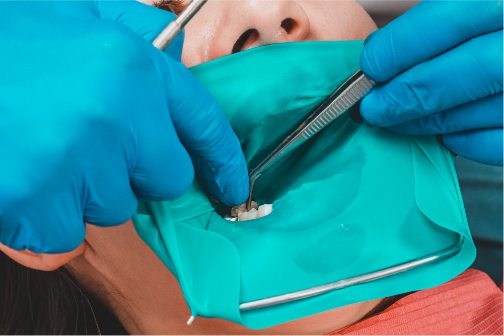 ラバーダムによる無菌環境