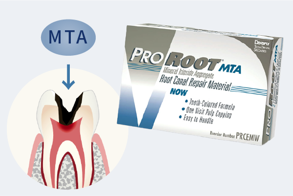 ニッケルチタンファイル