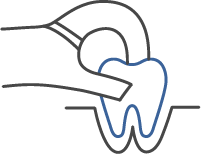 親知らず(埋伏歯)