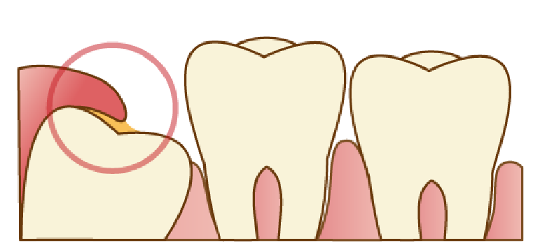 親知らずを放置するリスク