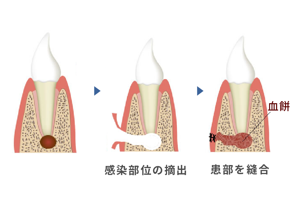 外科的歯内療法